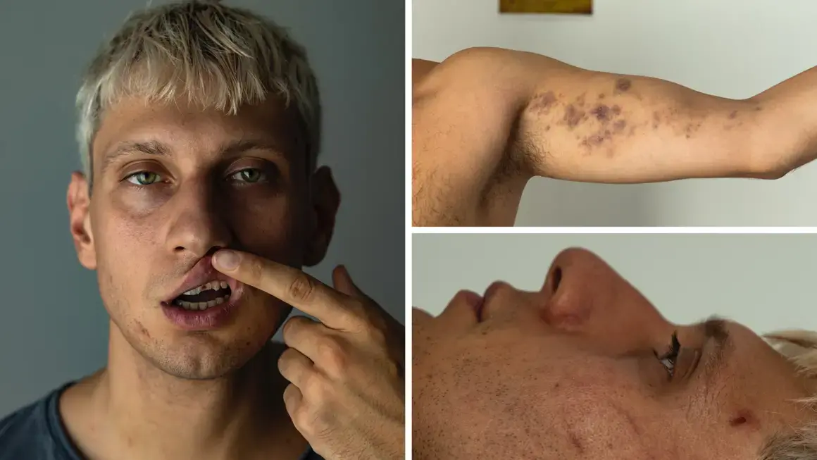 Втори побой над младеж от охранители - този път в пловдивска дискотека